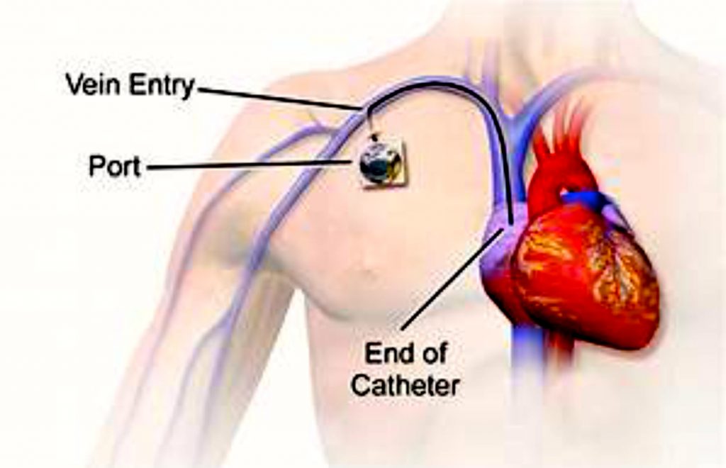 6 Port a Cath My Saving Grace RebeKemi 6 Port a Cath My Saving Grace RebeKemi
